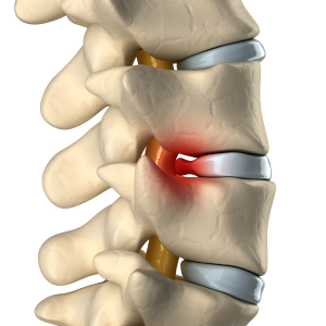 Spinal Disc Complaints